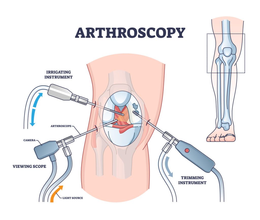 arthroscopy use to knee surgery